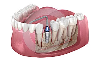 Implant abutment fixation procedure. Medically accurate 3D illustration of human teeth and dentures concept photo