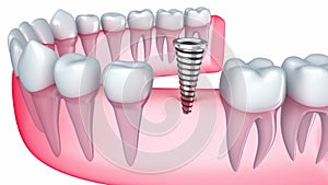 Implant is embedded in the gum