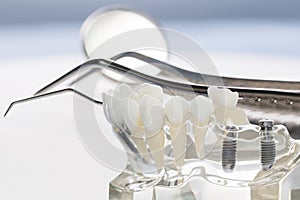 Implant and orthodontic model.