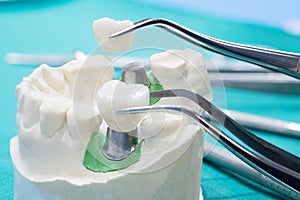 Implant and prosrthodontic model.