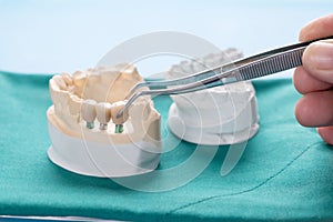 Implant and prosthodontic model.