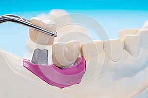 Implant Prosthodontics or Prosthetic