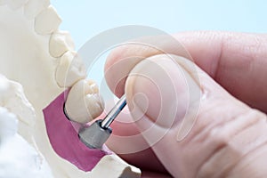 Implant Prosthodontics or Prosthetic