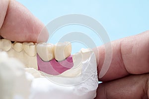 Implant Prosthodontics or Prosthetic