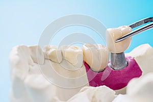 Implant Prosthodontics or Prosthetic