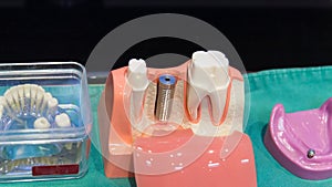 The implant substructure teeth model photo