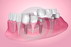 Implant supported fixed bridge.