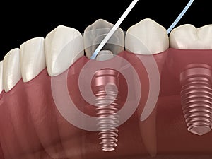 Implant tooth cleaning with dental floss. Medically accurate 3D illustration