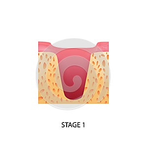 Implantation First Stage Composition