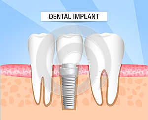 Implantation of human teeth. Dentistry. Dentistry. Realistic dental implant structure with all parts: crown, abutment, screw. Heal photo