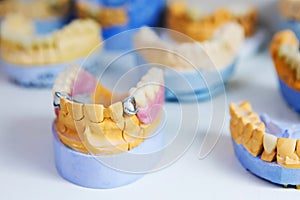 Implantation and manufacture of dental prostheses. Man\'s jaw with teeth on the table in the dental laboratory