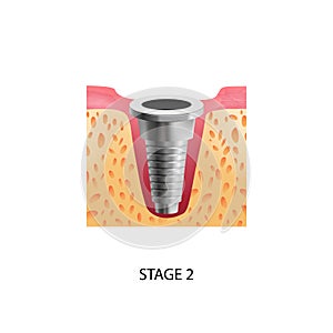 Implantation Second Stage Composition