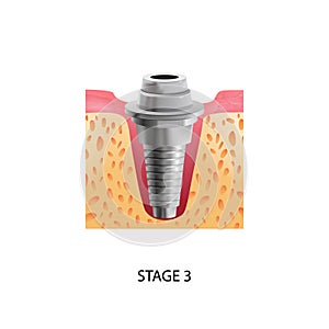 Implantation Third Stage Composition