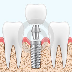 Implantation of tooth process in realistic style. Stomatological restoration, rehabilitation on implant. photo