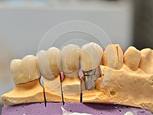 Implanted porcelain teeth