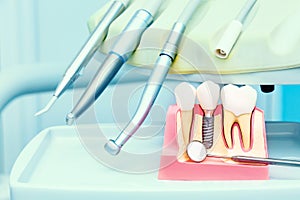 Implantology concept. Dental implants with mirror in dental clinic photo