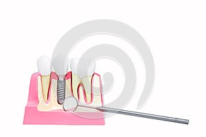Implantology. Dental implants and human jaw model with dental mirror isolated on white background
