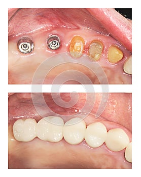 Before and after - implants and crowns