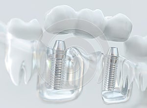 Implants with dental bridge - 3d rendering