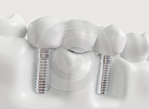 Implants with dental bridge - 3d rendering