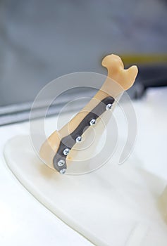 Implants and prostheses printed on 3D printer from biocompatible titanium powder