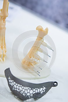 Implants and prostheses printed on 3D printer from biocompatible titanium powder