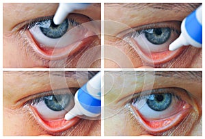 Instill eyedrops or ointment on eye photo