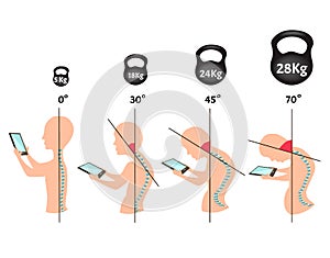 Improper posture symptoms. Stage Text Neck Syndrome. Spinal curvature, kyphosis, lordosis, scoliosis, arthrosis