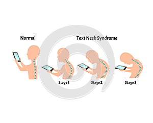 Improper posture symptoms. Stage Text Neck Syndrome. Spinal curvature, kyphosis, lordosis, scoliosis, arthrosis