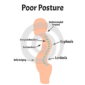 Improper posture symptoms. Text Neck Syndrome. Spinal curvature, kyphosis, lordosis, scoliosis, arthrosis. Improper