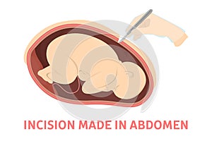 Incision making stage of birth via cesarean section