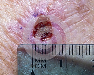 Incisional Biopsy Site on Male Hand
