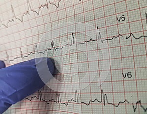 Incorrect ecg record photo