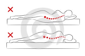 The incorrect spine alignment when sleeping. photo