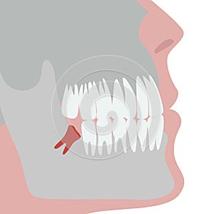 Incorrectly growing wisdom tooth.