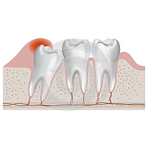 Incorrectly growing wisdom tooth.