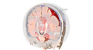 The increased pressure of subdural hematomas can lead to tissue shifts in the brain (brain herniations