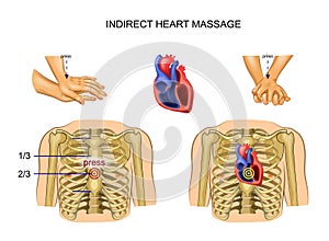 Indirect heart massage photo