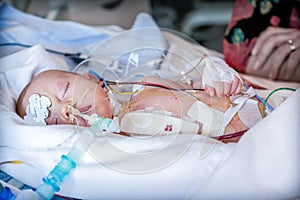 Infant, child in intensive care unit after heart surgery.