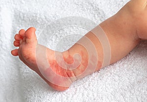 Hemangioma red birthmark on the leg of newborn baby photo