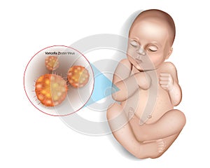 Infant presenting with the characteristic blisters of chickenpox. Chickenpox or varicella, is a highly contagious