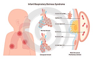 Infant respiratory distress syndrome. Congenital pathology of baby's