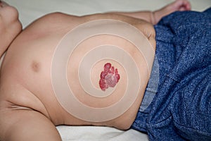 Infantile Hemangioma red birthmark on the baby`s belly photo
