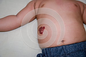 Infantile Hemangioma red birthmark on the baby`s belly