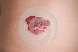 Infantile Hemangioma red birthmark on the baby`s belly