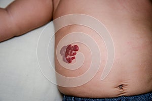 Infantile Hemangioma red birthmark on the baby`s belly