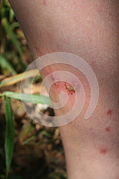 Infected leg sores on a boy photo