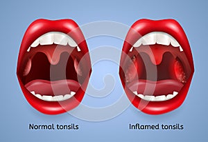 Infected Tonsils Inflammation Vector Concept