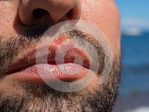 Infection on man face closeup. Sun burn or bacterial infection. Skin medical problem. Virus or bacterial inflammation
