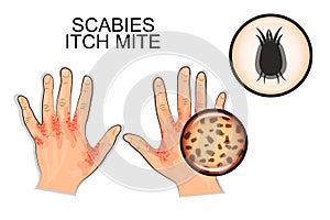 The infection of scabies. itch mite photo